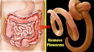 How to Get Rid of Pinworms Overnight  Top 9 Home Remedies for Pinworms During Pregnancy [upl. by Alyosha597]