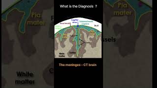 The meninges  CT brain Anatomy Meninges Quiz 10 radiologychannel007 [upl. by Echo]