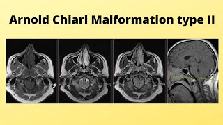 Arnold chiari malformation TYPE II [upl. by Hanus]