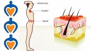 Shingles  The causes symptoms treatment and prevention [upl. by Naoh]