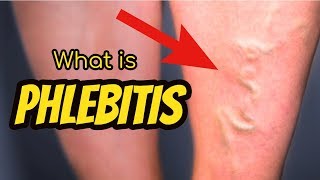 What is Phlebitis [upl. by Geiger]