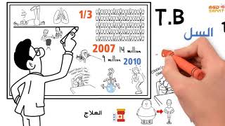 Tuberculosis  Types causes Pathogenesis Diagnosis treatment [upl. by Ecinhoj]