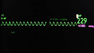 Ventricular tachycardia on an ECG monitor [upl. by Ardnahs]