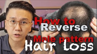 How to Reverse Male Pattern Baldness  Hair Loss in Men [upl. by Harak]