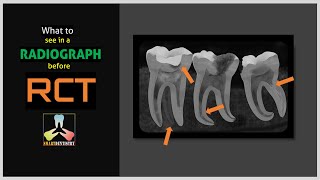 What to see in a radiograph before RCT [upl. by Icats441]