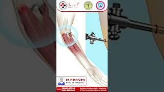 Tennis Elbow Treatment When Surgery Becomes Necessary  Dr Mohit Garg [upl. by Rimisac222]