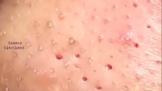 Blackhead Removal on his nose  Acne Treatment  Remove Blackhead removeblackhead [upl. by Eenad]