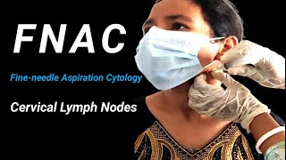 FNAC in the Diagnosis of Cervical Lymph Nodes in Neck। [upl. by Downing113]