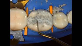 Complex Amalgam Restoration by Dr Saulo Geraldeli [upl. by Giffard564]