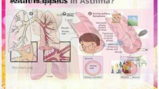 Asthma inhaler and spacer usePart 1 [upl. by Anawek]