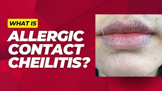 What is allergic contact cheilitis [upl. by Esilec]