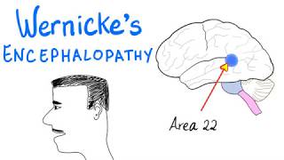 Wernickes Aphasia Fluent Aphasia  Neurology [upl. by Namzzaj]