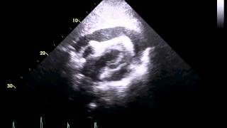 Echocardiogram of a Patient With Cardiac Tamponade [upl. by Placido]