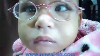 Nystagmus Blockage Syndrome  الرأرأة  العيون الراقصة [upl. by Atsiuqal]