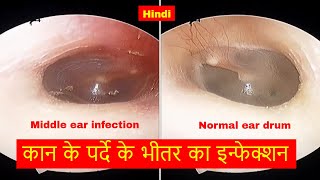 कान का पर्दा क्यों लाल हो गया है। How to Diagnose and Treat Acute Otitis Media [upl. by Adav]