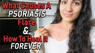 WHAT CAUSES A PSORIASIS FLARE amp HOW TO HEAL IT FAST [upl. by Bittencourt]