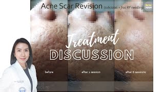 Acne Scar Revision Subcision  Fractional Radiofrequency Microneedling [upl. by Lem382]