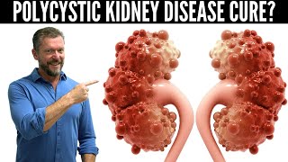 Polycystic Kidney Disease Breakthrough New Research in PKD  2024 [upl. by Elise]