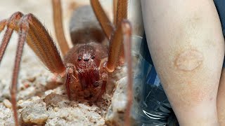 Brown Recluse Spider Bite Story 🕷 They Nearly Lost Their Leg [upl. by Cud625]