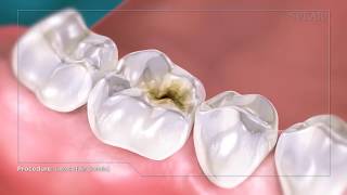 Composite Fillings [upl. by Hayne]