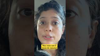 5 meses de roacutan e marcas de espinhas explore roacutan foryou acne [upl. by Lamori803]