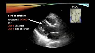 Basic Cardiac Ultrasound Views and Pathology  Echocardiography [upl. by Nonnarb]