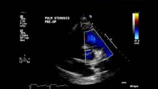 Moderate Pulmonary stenosis [upl. by Elleinet613]