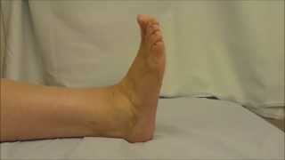 Movement After Ankle Fusion [upl. by Lose]