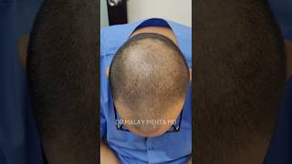 4800 Grafts Unbelievable Transformation shorts hairtransplant drmalaymehta [upl. by Clerissa]