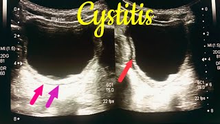 Cystitis kya hota hai  cystitis in children  cystitis symptoms  cystitis ultrasound [upl. by Ynneg]