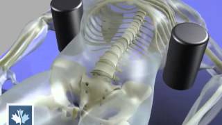 Sciatica  Spinal Decompression  Back Clinics of Canada [upl. by Gearalt403]