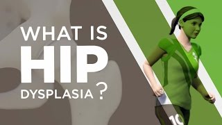 What is Hip Dysplasia [upl. by Eillil]