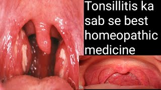 tonsillitis homoeopathic medicinetonsil homeopathy treattonsil homeopathy treatmenttonsil homeopathy [upl. by Renrut]