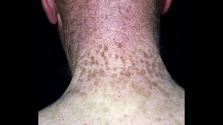 The Language of Dermatology Part I Plus Nevus Flammeus Lentigo Ephelides freckles and Melasma [upl. by Eirased802]