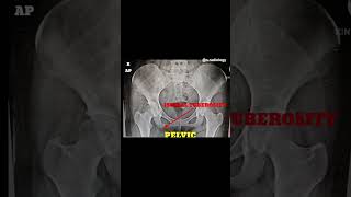 Anatomy of pelvic x ray radiology shortvideo [upl. by Henryetta]