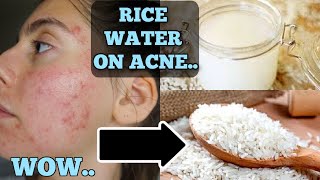 I Tested Rice Water for 1 Week Straight  SHOCKED BY THE RESULTS THIS IS HOW MY SKIN LOOKS NOW [upl. by Anneirb]