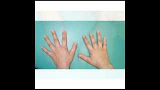 Brachydactyly Treatment  Symptoms and Causes  Diagnosis  Prevention health [upl. by Dhruv]