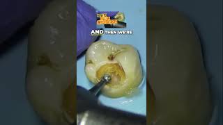 Preserving Tooth Structure Effective Decay Removal Techniques [upl. by Ocram172]