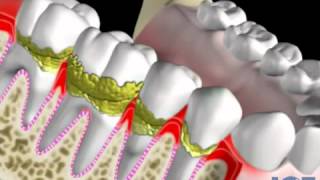 Sarro problemas periodontales pérdida osea y movilidad Dental Advance [upl. by Ylahtan]