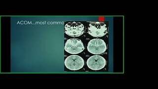 Stroke Case based scenario Dr Md Yousuf Ali [upl. by Novyert]