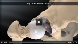 Hip Labral Reconstruction [upl. by Lahtnero]