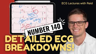 EKG Test Yourself  ECG Case Study 140 [upl. by Kohl]