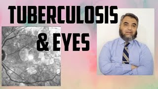 TUBERCULOSIS AND EYES Tuberculosis EyeinfectionRifampicinisoniazidethambutol [upl. by Checani735]