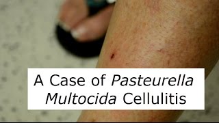 P Multocida Cat Scratch Infection [upl. by Enelaehs742]