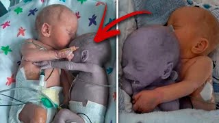 Mom puts the baby to the dying Twin and five minutes later a real Miracle happens [upl. by Mixie]