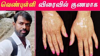 வாங்க ஃபிரண்ட்ஸ் கன்னியாகுமரி மருத்துவத்திற்கு போகலாம் 🌿 Vitiligo Treatment Awareness [upl. by Raffin703]