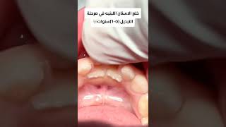 خلع الأسنان اللبنية في مرحلة التبديل dentist drabdullahsultandentist dentitio اكسبلورexplore [upl. by Petrie]