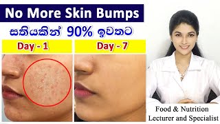 Skin Care Routine For Oily Acne Prone SkinOily Acne Prone स्किन के लिए स्किन केयर रूटीन In HINDI [upl. by Sadinoel]