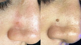 Removing a mole with plasma Fibroblast video before and after [upl. by Diann]