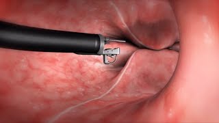 What Happens During the Endoscopic Sleeve Gastroplasty ESG Procedure [upl. by Nilad]